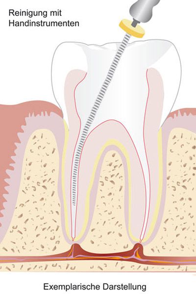 Wurzelkanalbehandlung