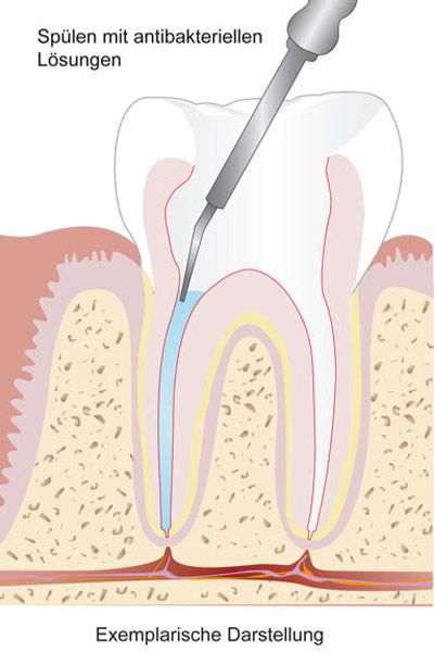 Wurzelkanalbehandlung