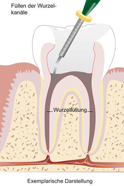 Wurzelkanalbehandlung